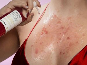 How Cherry Clears Acne (Inside + Out)