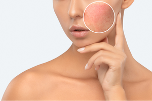 Your Guide to Hives on the Face