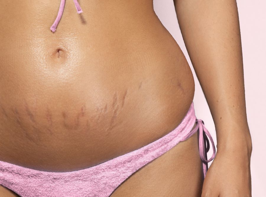 Are Stretch Marks Genetic?