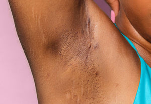 How to Get Rid of Dark Underarms in 6 Steps